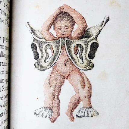 An illustration of a breech birth An illustration of a breech birth